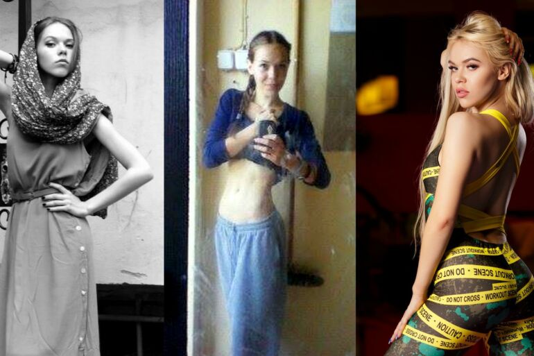 Anoreksija sirgusi lietuvaitė Kristina: „Sunku pripažinti