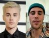 Atlikėją Justin Bieber ištiko veido paralyžius: kas yra Ramsay Hunt sindromas