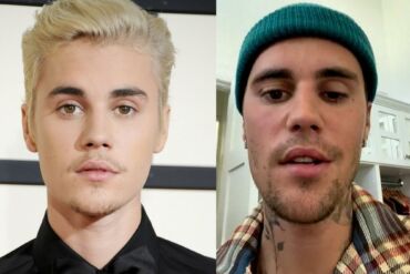 Atlikėją Justin Bieber ištiko veido paralyžius: kas yra Ramsay Hunt sindromas