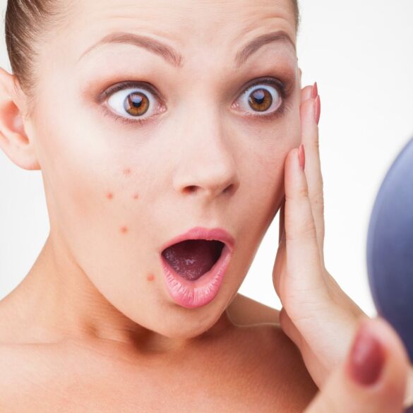 Kaip sumažinti spuoguotos odos blizgesį? Komentuoja specialistė