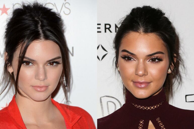 Kendall Jenner prisipažino: ją kankino baisios odos problemos (FOTO paauglystėje)