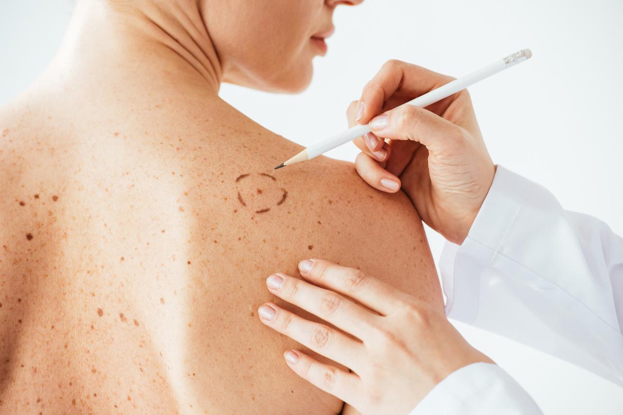 Melanoma serganti vilnietė: neįtariau