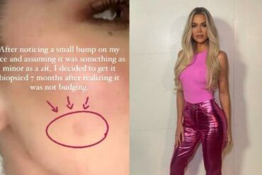 Nuo socialinių medijų žvaigždės Khloé Kardashian veido buvo pašalintas auglys