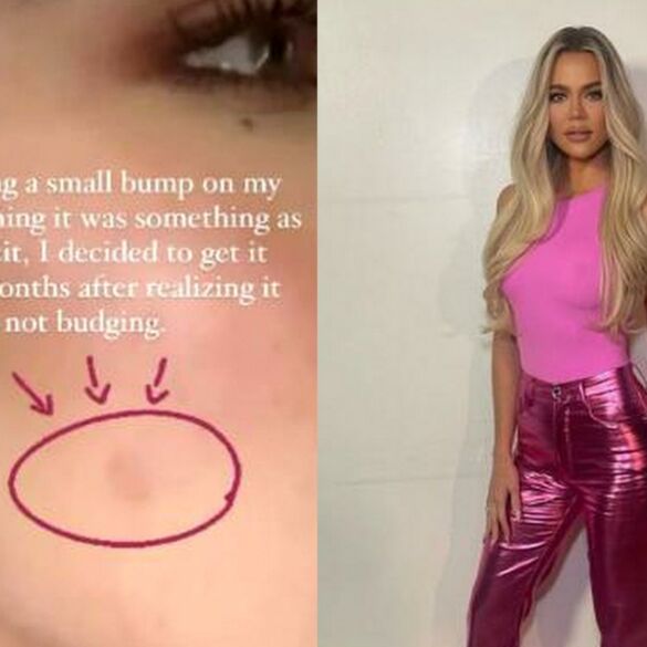 Nuo socialinių medijų žvaigždės Khloé Kardashian veido buvo pašalintas auglys